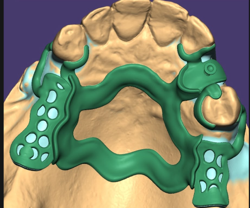 Roach Prosthesis — Removable framework, precision clasp design